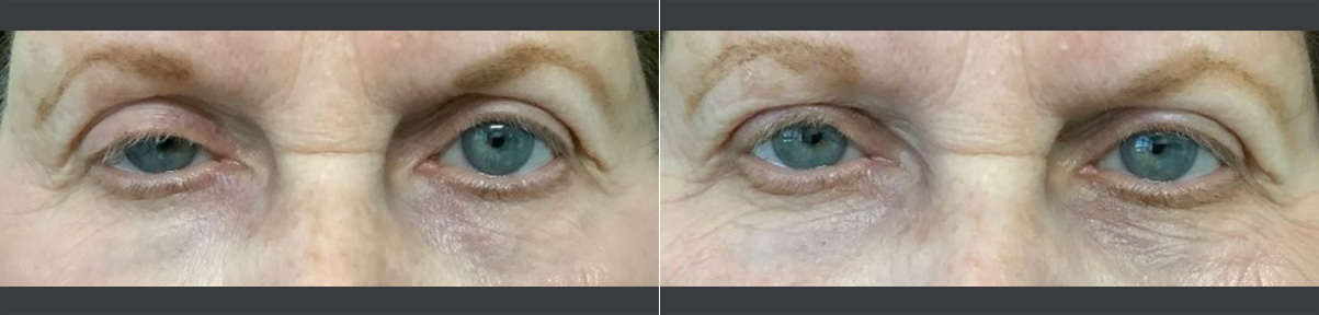 before and after 16
