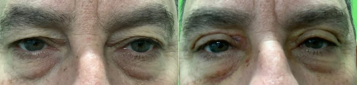 This patient is 62 years old and thought his eyes looked heavy.  He wanted his eyes to look more open and to feel less tired.  He noted that he often looked angry in his pictures as well.  Dr Dewan performed a male blepharoplasty and brow elevation on both sides.This post-operative photo is from 1 week after surgery, so swelling and bruising are still visible.