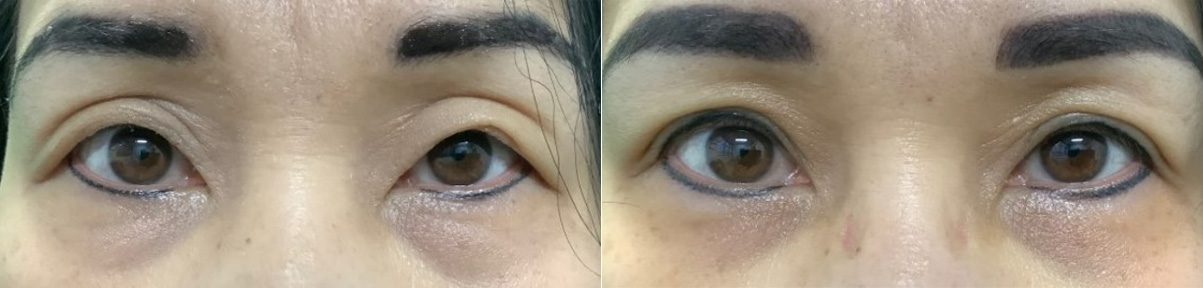 This patient is 50 years old and had had an Asian blepharoplasty many years ago, before she saw Dr. Dewan.  She mentioned that she “hated” her eyes, that she had lost her confidence and worst of all, that she did not look like herself after her previous surgery.  She did not think her eyes were symmetrical and thought her lids appeared “unusual.”  Her goal was to look “more normal” and “more like herself.”  To help her achieve her goals, Dr. Dewan performed a revision Asian blepharoplasty, and also defined her crease on both sides.  This photo is from 12 days after her surgery.  Despite having a lot of healing left, she was thrilled with the outcome and felt she could be confident again!