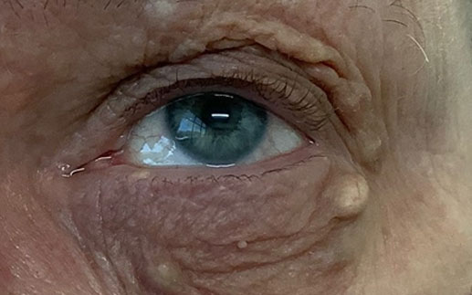 This patient is 65 years old and had multiple cystic growth on her eyelid skin.  She was particularly bothered by the large whitish cyst.  This was removed in the office with a quick procedure.