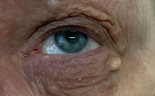 Eyelid growths deals