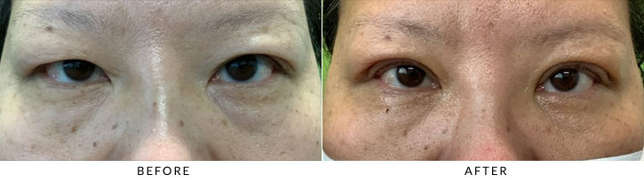 Asian Blepharoplasty Before & After Photo - Patient 1