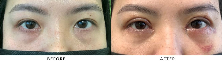 Asian Blepharoplasty Before & After Photo - Patient 2