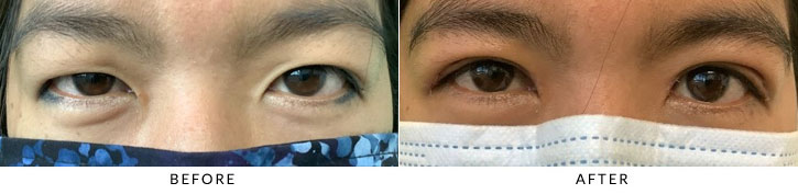 Asian Blepharoplasty Before & After Photo - Patient 3