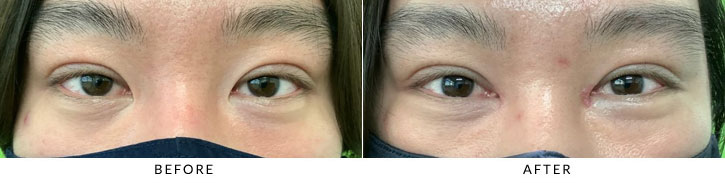 Asian Blepharoplasty Before & After Photo - Patient 4