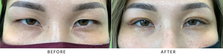 Asian Blepharoplasty Before & After Photo - Patient 5