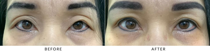 Asian Blepharoplasty Before & After Photo - Patient 6