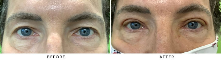Male Blepharoplasty Before & After Photo - Patient 1