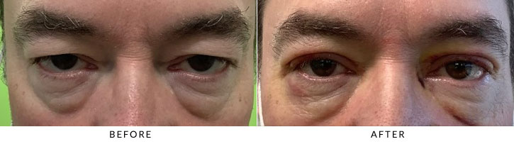 Male Blepharoplasty Before & After Photo - Patient 2