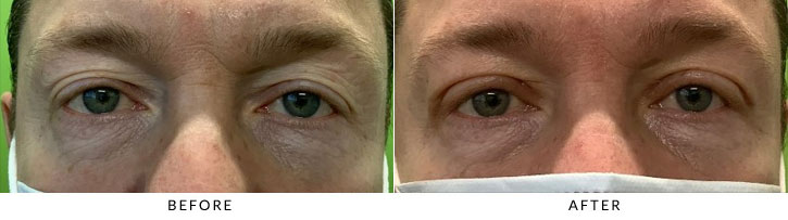 Male Blepharoplasty Before & After Photo - Patient 3