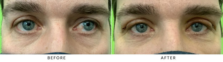 Male Blepharoplasty Before & After Photo - Patient 4