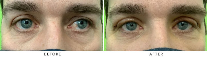 Male Blepharoplasty Before & After Photo - Patient 4