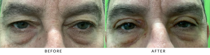 Male Blepharoplasty Before & After Photo - Patient 5