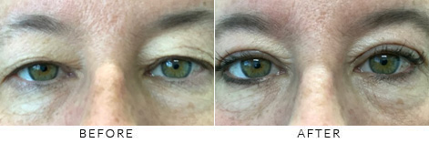 Upper Eyelid Blepharoplasty Gallery