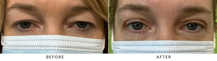 Upper Eyelid Blepharoplasty Before & After Photo - Patient 1