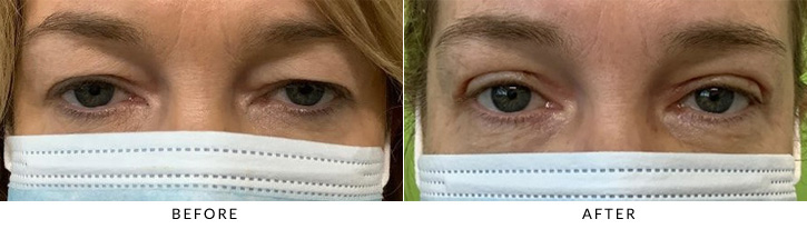 Upper Eyelid Blepharoplasty Before & After Photo - Patient 1