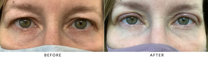 Upper Eyelid Blepharoplasty Before & After Photo - Patient 10