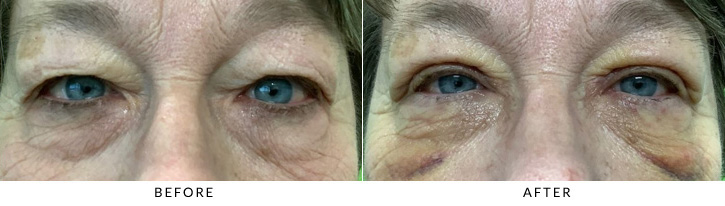 Upper Eyelid Blepharoplasty Before & After Photo - Patient 7