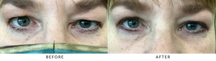 Upper Eyelid Blepharoplasty Before & After Photo - Patient 8