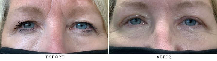 Upper Eyelid Blepharoplasty Before & After Photo - Patient 9