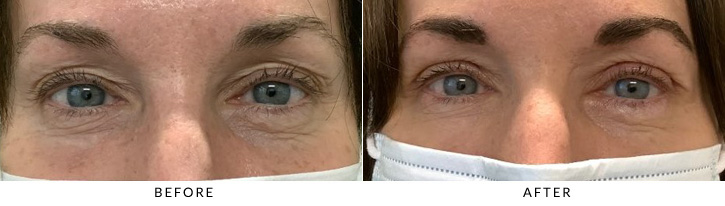 Upper Eyelid Blepharoplasty Before & After Photo - Patient 2