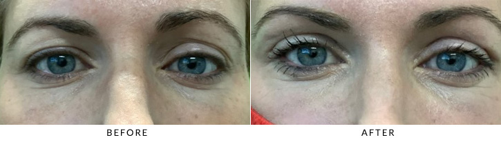Upper Eyelid Blepharoplasty Before & After Photo - Patient 3