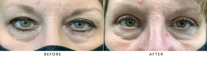 Upper Eyelid Blepharoplasty Before & After Photo - Patient 4