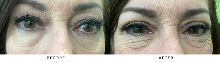 Upper Eyelid Blepharoplasty Before & After Photo - Patient 5