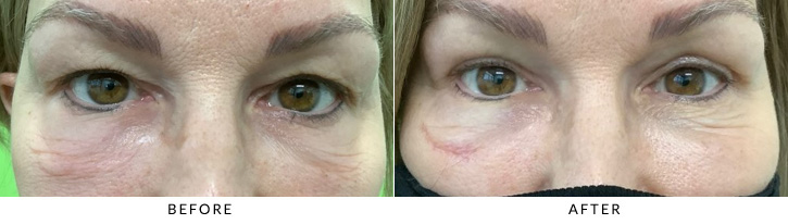 Upper Eyelid Blepharoplasty Before & After Photo - Patient 6