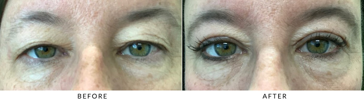 Upper Eyelid Blepharoplasty Before & After Photo - Patient 7