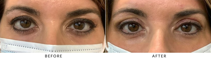 Upper Eyelid Blepharoplasty Before & After Photo - Patient 8