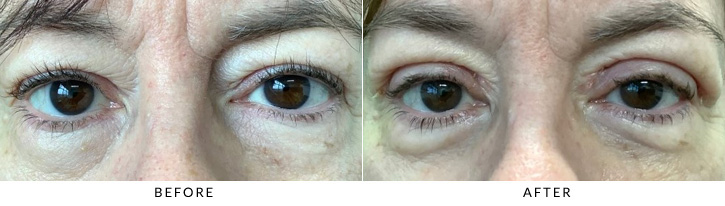 Upper Eyelid Blepharoplasty Before & After Photo - Patient 9