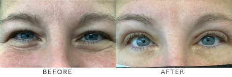 Brow Lift Gallery