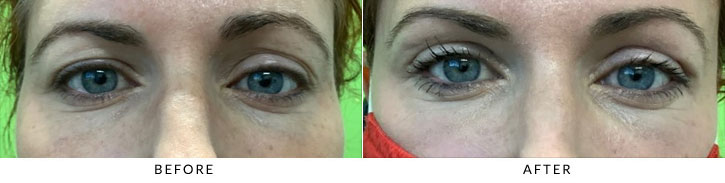Brow Lift Before & After Photo - Patient 1