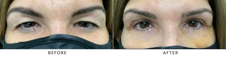 Brow Lift Before & After Photo - Patient 2