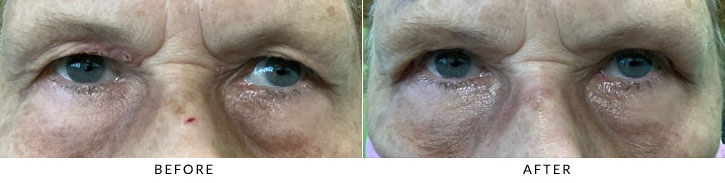 Brow Lift Before & After Photo - Patient 3