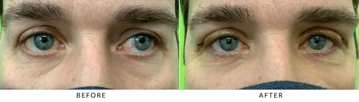 Brow Lift Before & After Photo - Patient 4