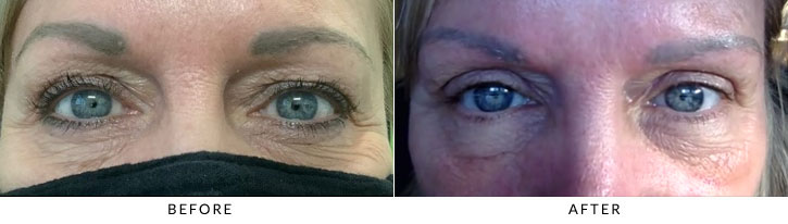 Brow Lift Before & After Photo - Patient 5