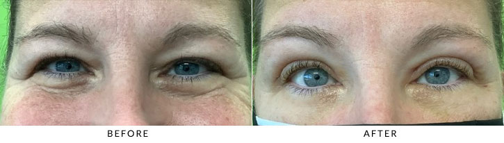 Brow Lift Before & After Photo - Patient 6