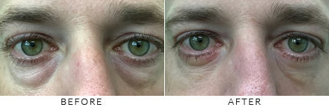 Lower Eyelid Blepharoplasty Gallery