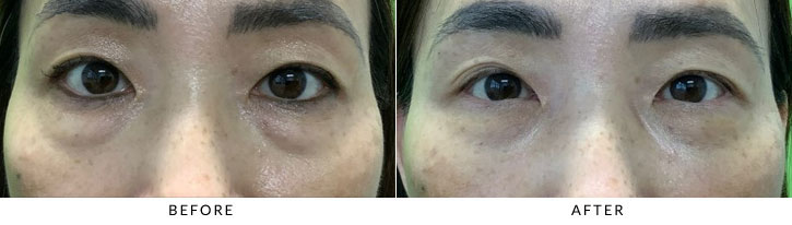 Lower Eyelid Blepharoplasty Before & After Photo - Patient 1
