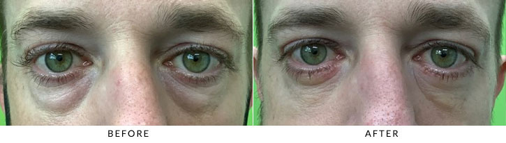 Lower Eyelid Blepharoplasty Before & After Photo - Patient 2