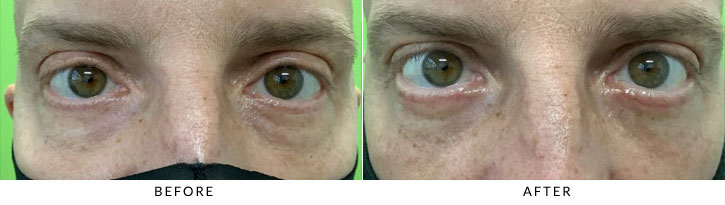 Lower Eyelid Blepharoplasty Before & After Photo - Patient 4