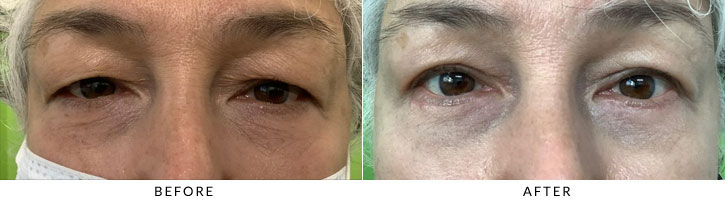 Lower Eyelid Blepharoplasty Before & After Photo - Patient 5