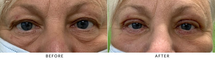 Lower Eyelid Blepharoplasty Before & After Photo - Patient 6