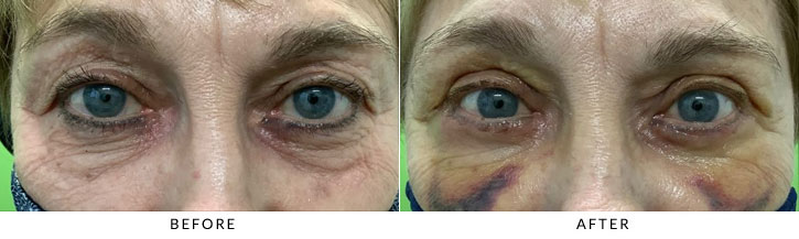 Lower Eyelid Blepharoplasty Before & After Photo - Patient 7