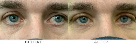 Male Blepharoplasty Gallery