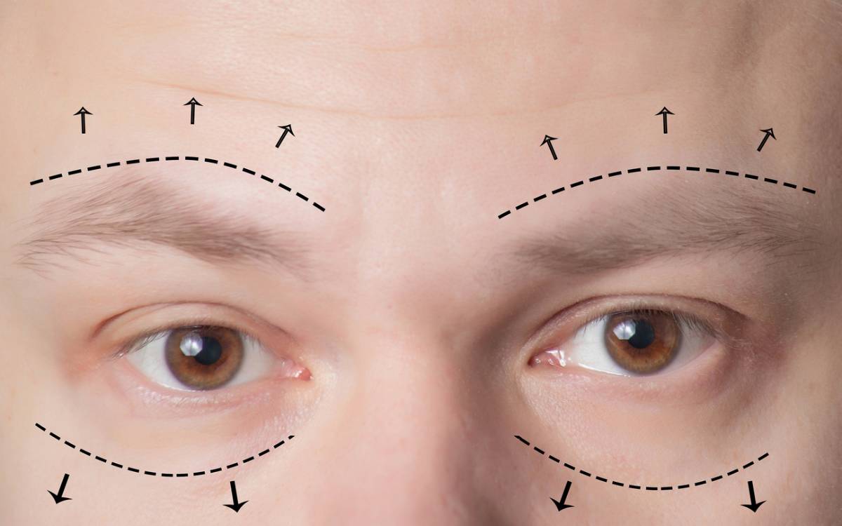 Example male eyelid surgery which is a top cosmetic procedure for men