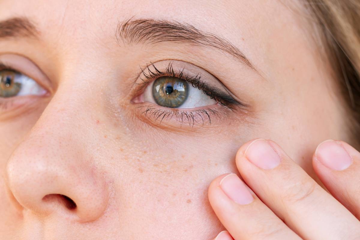featured image for how to get rid of dark circles under the eyes