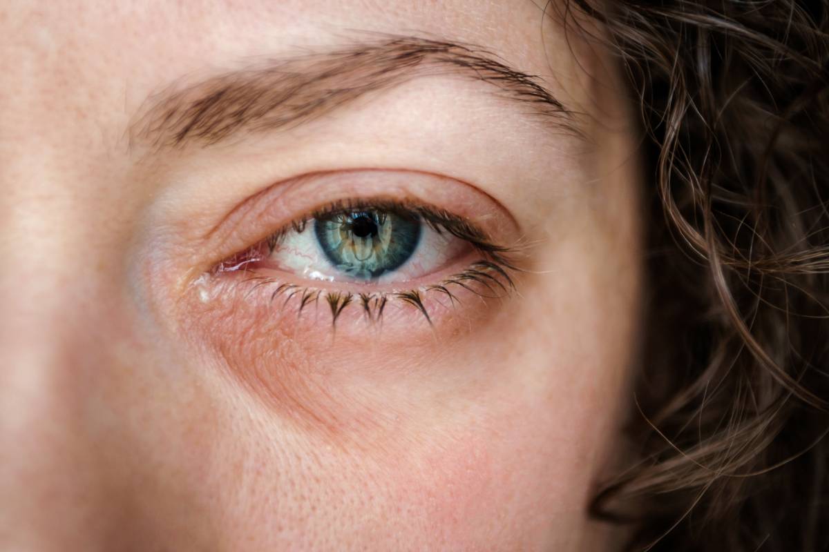 Close up of woman with red, watery eyes.